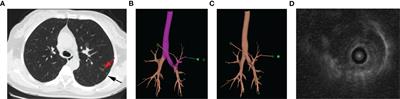 Accurate and non-invasive localization of multi-focal ground-glass opacities via electromagnetic navigation bronchoscopy assisting video-assisted thoracoscopic surgery: a single-center study